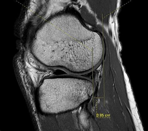 Signs of ACL tear on MRI- Resident's Corner - Sumer's Radiology Blog