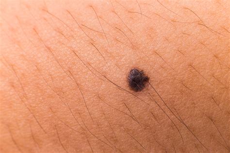 Best Way to Beat Melanoma is to Know the Symptoms – Health Essentials from Cleveland Clinic