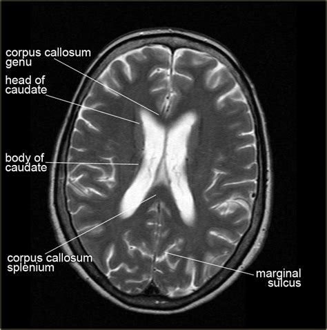 Brain Lobe Anatomy Mri