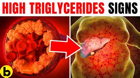 High Triglycerides Warning Signs You Should Know About - YouTube