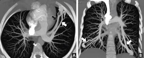 Lung Ct Scan Without Contrast