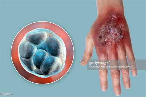 Protothecosis Infection On A Human Hand Illustration High-Res Vector Graphic - Getty Images