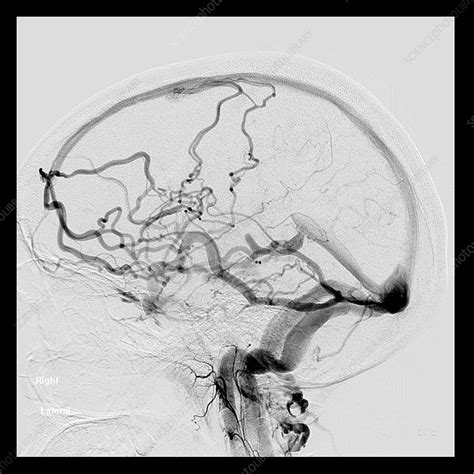 Carotid Cavernous Sinus Fistula, MRI - Stock Image - C027/1841 ...