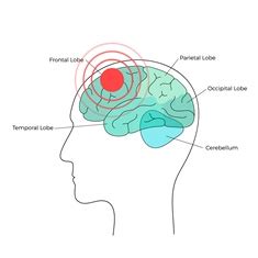 Frontal Lobe Injuries in Florida | Browning Law Firm, P.A.