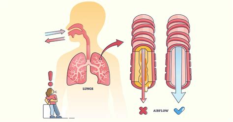 Cystic Fibrosis: Overview and Practice Questions