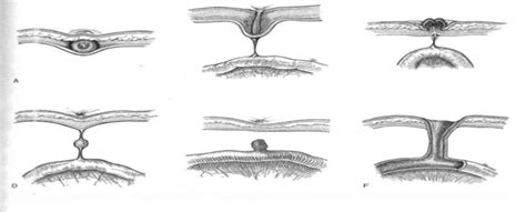 Omphalomesenteric Duct Remnants