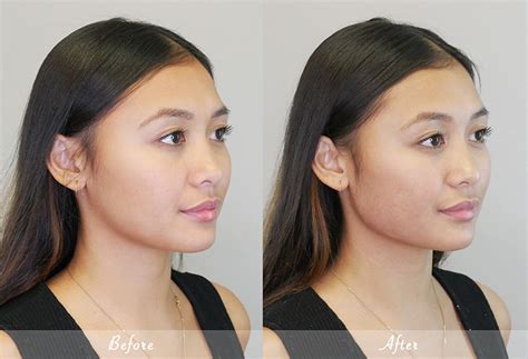 The Importance of Jawline Contouring for Both Men and Women