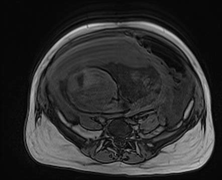 Sigmoid Volvulus Mri