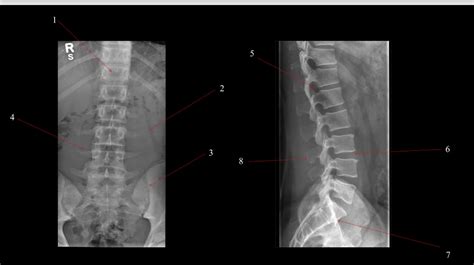 Diagram of Lumbar Spine Xray | Quizlet