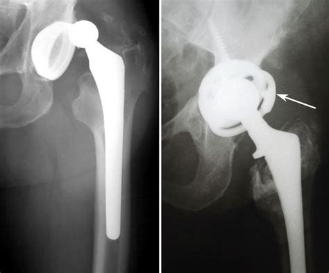 Revision Total Hip Replacement - OrthoInfo - AAOS (2023)