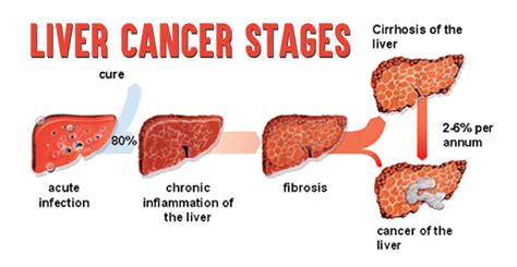 Liver Cancer Stages- How Stages of Lung Cancer are Determined!