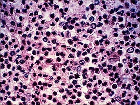 How to differentiate acute vs. chronic inflammation in sections | Pathology Student