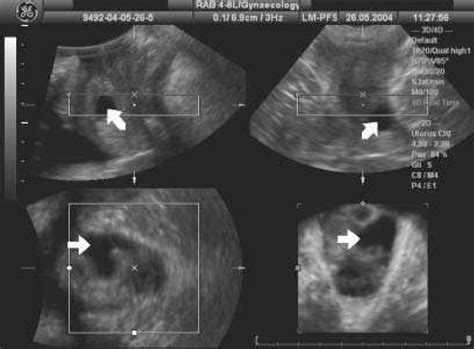 Gartner Gland Cyst