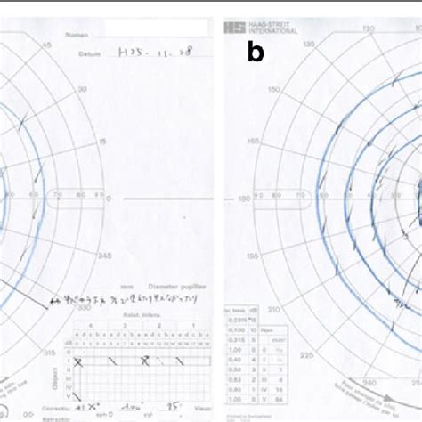 Goldmann visual field test after 2 weeks. Goldmann visual field test... | Download Scientific ...