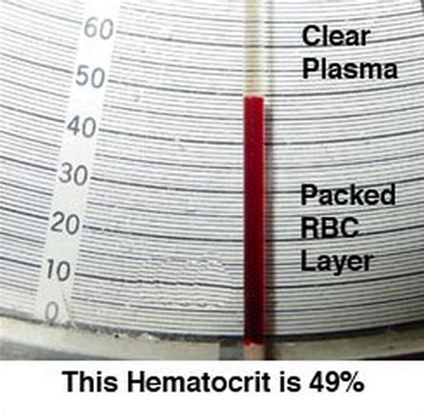 HCT Blood Test Results: The Important Things you Need to Know