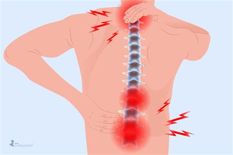 Spinal Osteoarthritis