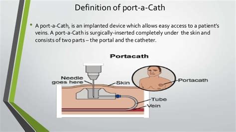 Port a-cath