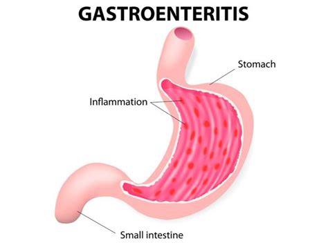 10 Beneficial Home Remedies for Gastroenteritis | Organic Facts