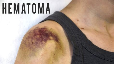 Home Remedies To Get Rid Of A Hematoma - YouTube