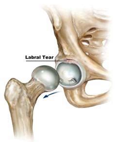 What the Hip!?!: torn labrum