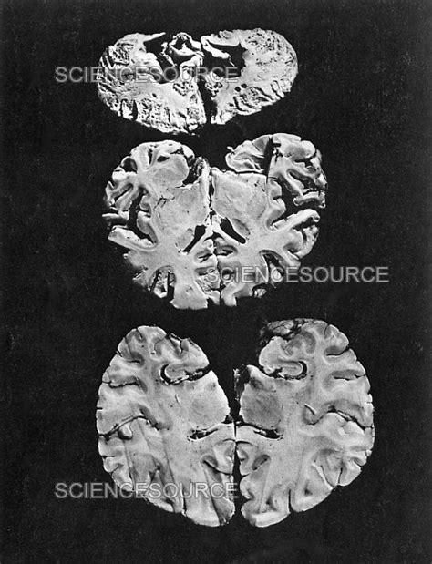 Minamata Disease | Stock Image - Science Source Images