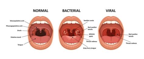 Why is my uvula swollen? — Pain Free Dentist Sydney