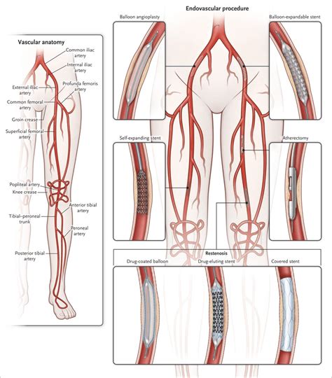 PAD Specialist - Center for Advanced Cardiac and Vascular Interventions