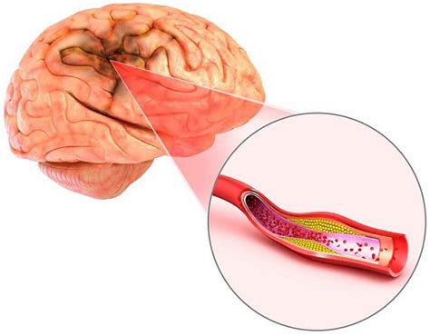 Cerebral atherosclerosis causes, symptoms, diagnosis, treatment & prognosis