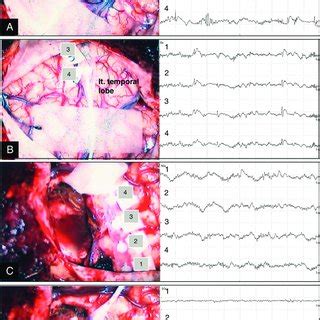 Case 1. Intraoperative ECoG prior to lesion resection showing... | Download Scientific Diagram