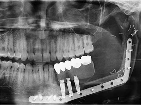 Bone Replacement Procedure Successfully Treats Children With Jaw Tumors - Dentistry Today