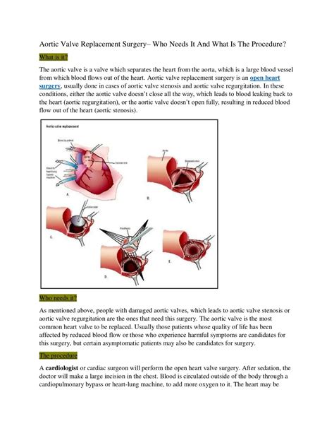 PPT - Aortic Valve Replacement Surgery– Who Needs It And What Is The ...