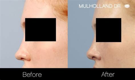 Rhinoplasty for Bulbous Nose Tip: Causes & Treatment