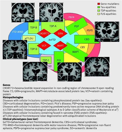 Frontotemporal dementia | The BMJ