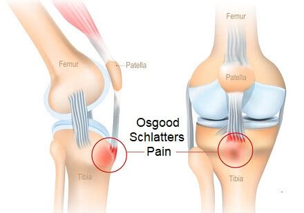 Pain Below The Knee: Causes & Treatment Of Pain Under The Knee