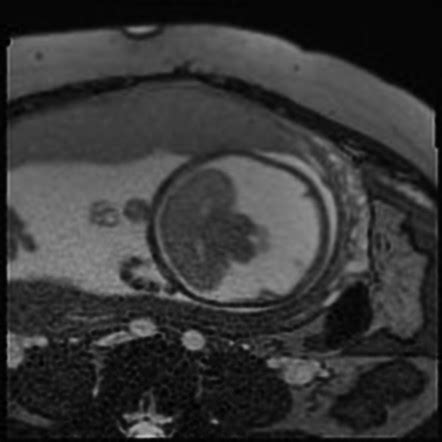 Alobar holoprosencephaly | Radiology Case | Radiopaedia.org