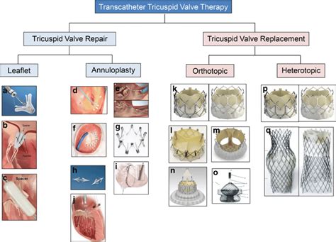 Tricuspid Valve Replacement