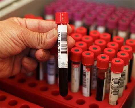 First 'Blood Test for Depression' Holds Promise of Objective Diagnosis - Newsweek