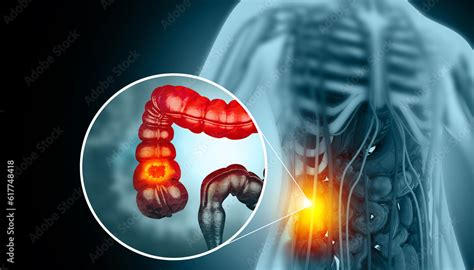 Colon cancer. Cancer attacking cell. Colon disease concept. 3d ...