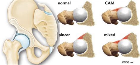 Hip Impingement