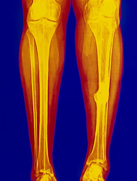 Coloured X-ray Of Fractured Shin Bone (tibia) Photograph by Mehau Kulyk