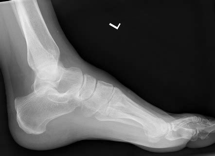 Calcaneal Stress Fracture