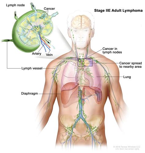 Non-Hodgkin Lymphoma Treatment - NCI