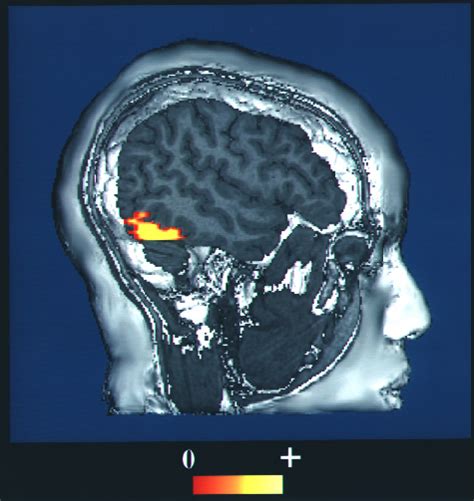 Fusiform Face Area Prosopagnosia