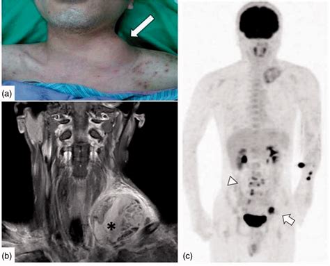 (a) Photograph of a large supraclavicular neck mass (long arrow) in the... | Download Scientific ...