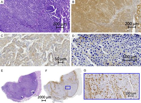 Immunohistochemical images. A. HE. Large cell neuroendocrine carcinoma ...