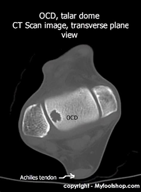 Talar Dome Fractures | Causes and treatment options | MyFootShop.com