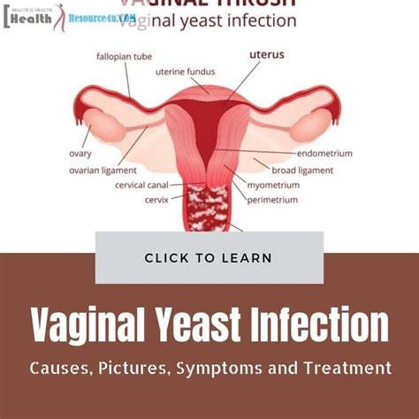 Pin on yeast infection and period