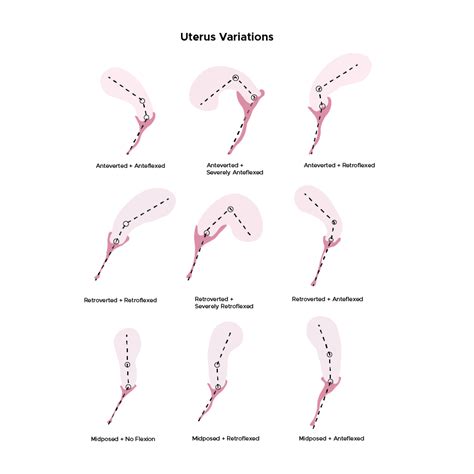 TiltedUterus — Most common: Anteverted + anteflexed (forward...