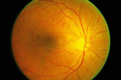 Blindness Due to Diabetic Retinopathy Surges Worldwide | Florida Eye Microsurgical Institute