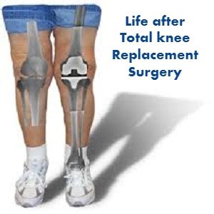 Life after Total knee Replacement Surgery | Dr. Amyn Rajani Blog